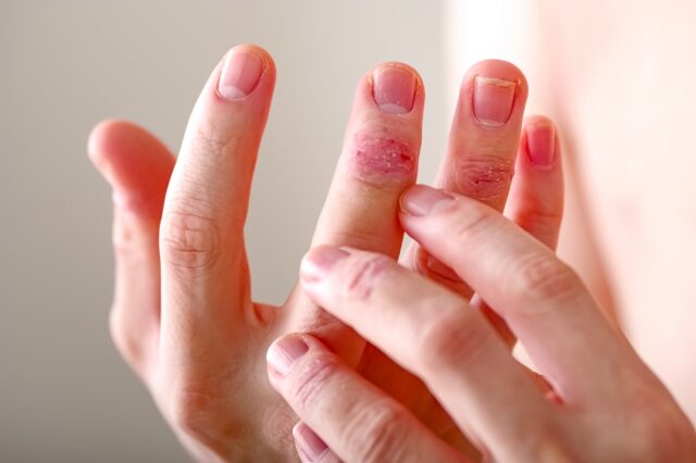 日本皮膚科学会のアトピー性皮膚炎に対する記載